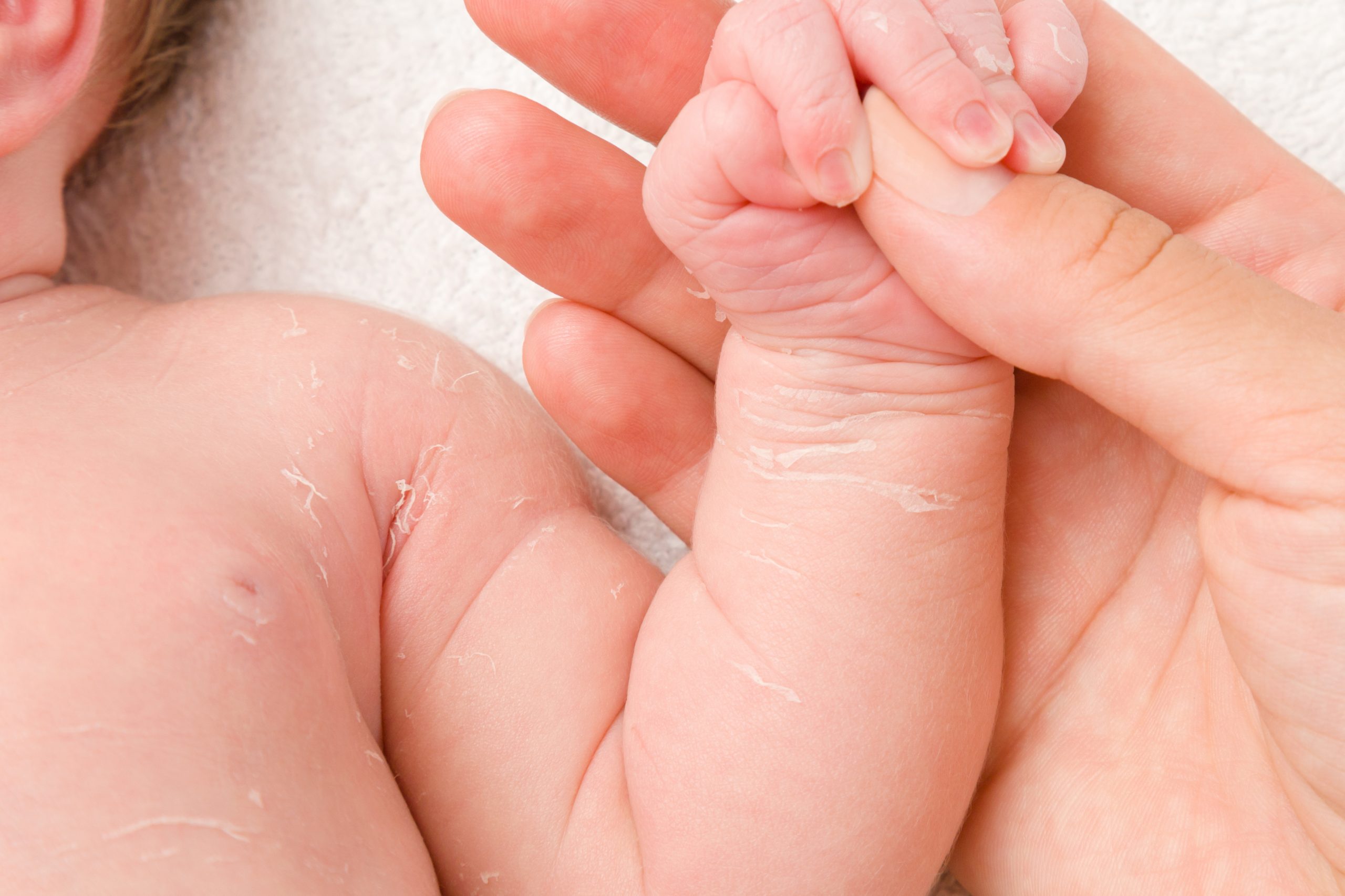 attent boog lip 5 natuurlijke oplossingen voor een baby met een droge huid - de Kleine  Keuken