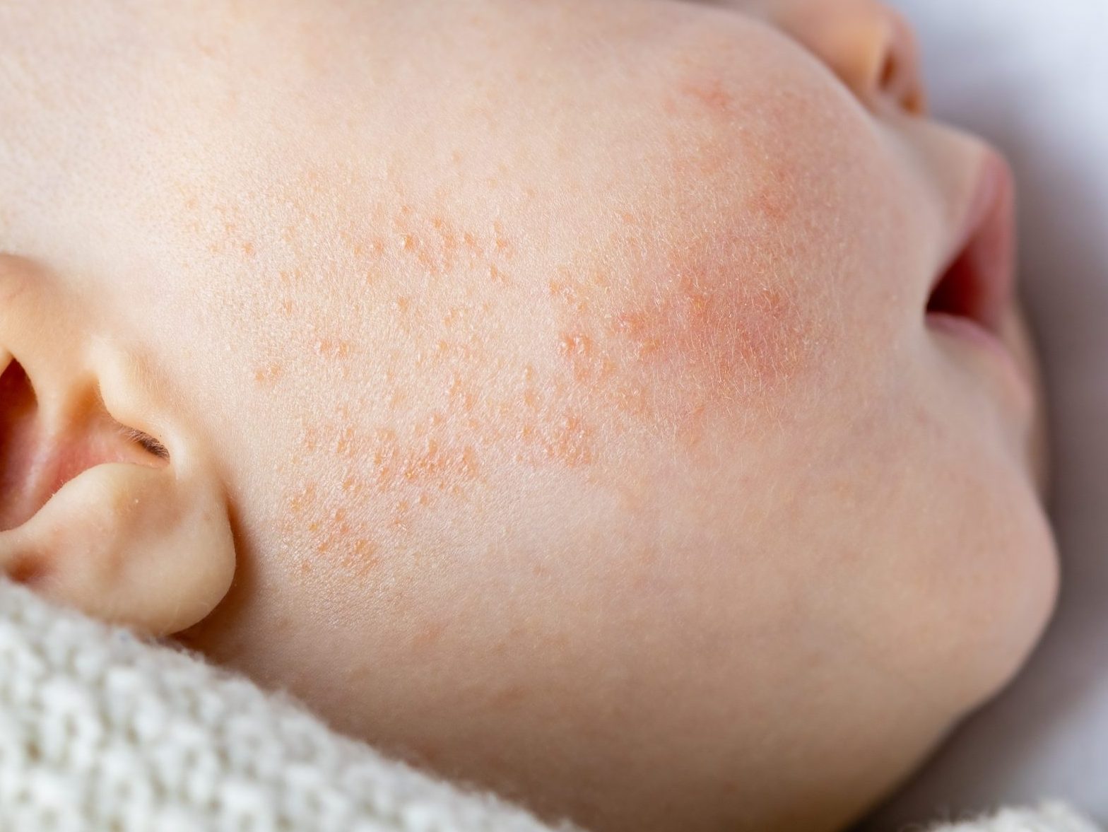 Empirisch apotheker Veronderstelling Baby acne: wat is het écht en wat kun je doen? - de Kleine Keuken